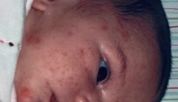 L’acné du nourrisson: symptômes et traitements